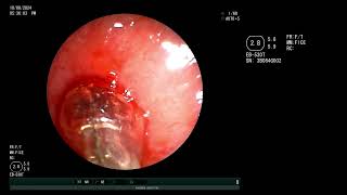 Emergent Central airway obstruction Subglottic stenosis  Dilatation and silicone stent placement [upl. by Prosser]