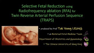 TRAPS twin reduced by Radiofrequency ablation [upl. by Llehcar]