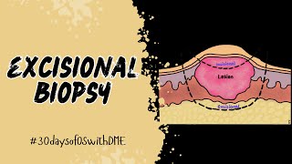 EXCISIONAL BIOPSY  30daysofOSwithDME [upl. by Ahcorb769]