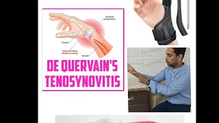 De Quervains tenosynovitis  thumb pain [upl. by Placidia]