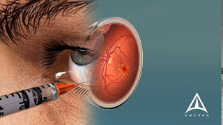 How Macular Degeneration Affects Your Vision  3D animation [upl. by Tobiah]