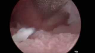 Watch a demonstration of a fibroid removal using the MyoSure XL tissue removal device [upl. by Annua753]