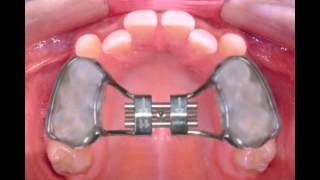 Palatal expanderbonded design [upl. by Agathy]