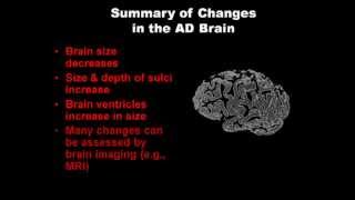 Changes in the Alzheimers Brain [upl. by Ayadahs]