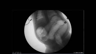 Pediatric Emergency POCUS Targeting Intussusception [upl. by Ycul]