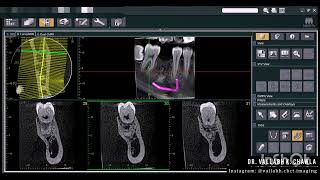 CONDENSING OSTEITIS  OPG vs CBCT 2D vs 3D IMAGING MODALITY [upl. by Cogen]