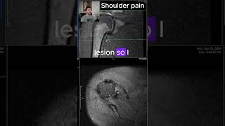 Glenoid labrum tear  MRI SCANS Ep 5 medicalimaging mriscan radiology shoulderpain [upl. by Aztiley]