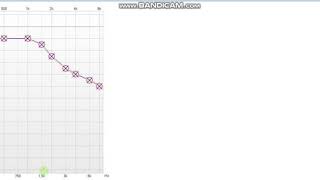 Presbycusis Hearing Loss Audiogram [upl. by Neryt]