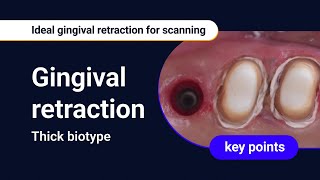 Thick biotype  Ideal gingival retraction for scanning [upl. by Elrak]