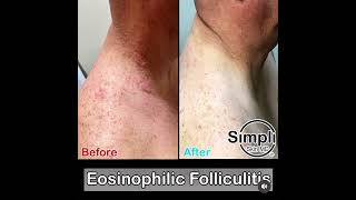 Eosinophilic Folliculitis [upl. by Ahsatsana503]