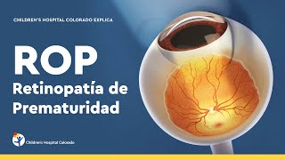 Retinopatía de la prematuridad diagnóstico y tratamiento [upl. by Ecnav244]