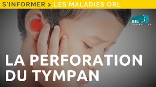 Perforation du tympan  Information patient [upl. by Geldens208]