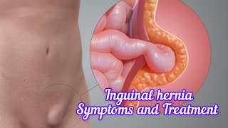 Inguinal hernia I Symptoms and Treatment I हर्निया क्या है DrAshishSachan [upl. by Nehte371]