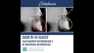 ortodonzia prima e dopo caso III classe dentale e scheletrica [upl. by Eenal]