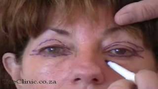 Eyelid surgery  correcting hoods and bags under the eyes [upl. by Amr819]