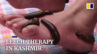 Kashmir residents seek leech therapy on Navroz [upl. by Ainosal]