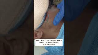 Excimer Laser Treatment for Vitiligo at Reincarnation Skin Clinic [upl. by Anomor704]