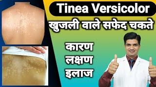 Skin की बीमारी  Tinea versicolor cause treatment [upl. by Kimball]