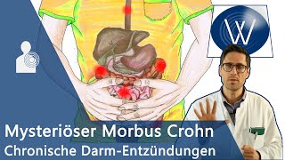 Morbus Crohn Ursache für unblutigen Durchfall amp Bauchschmerz Chronischentzündliche Darmerkrankung [upl. by Churchill77]