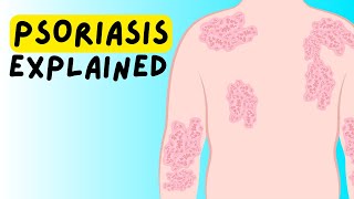 What is Psoriasis Definition Etiology Classification Pathophysiology Diagnosis Treatment [upl. by Haididej]