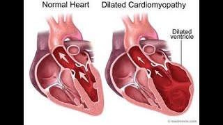 Cardiomiopatia dilatativa [upl. by Rudiger]