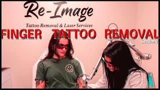 Tattoo Removal Session 2 [upl. by Battista208]