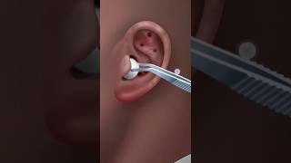 How do doctors clean earstreat earwaxearwax doctordoctergamingshorts [upl. by Paulina448]