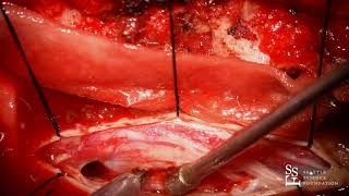 Live Surgery Resection of Spinal Tumor  Rod J Oskouian MD [upl. by Anor497]