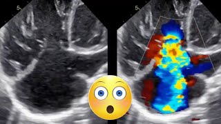 Post Tetralogy of Fallot repair echocardiography TOF [upl. by Allenod]