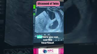 Ultrasound of Twin Pregnancy Explained by Dr Swapna Chekuri  HFC [upl. by Harad]