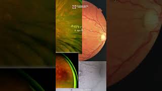 White Dot Syndromes ophthalmology optometry uveitis eyedisease choroidopathy [upl. by Coward]