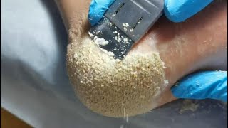 This is for lover of cheese Cracked heel treatment amp Callus removal Dead skin removal Foot care [upl. by Enehpets]