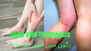 Deep vein thrombosis رگون میں خون جم جانا [upl. by Shaw]