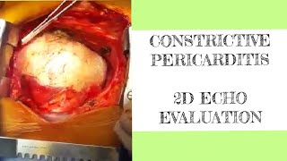 Constrictive pericarditis  2D ECHO evaluation [upl. by Nagle]