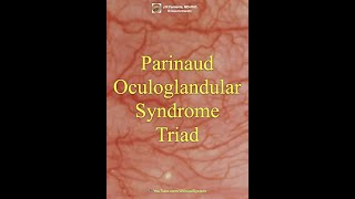 Parinaud Oculoglandular Syndrome Triad [upl. by Aicnilav856]