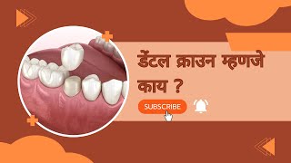 डेंटल क्राउन म्हणजे काय   What is a Dental Crown   Dental Crown  डेंटल क्राउन [upl. by Ian]