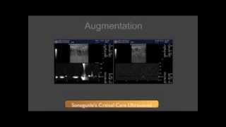 DVT Ultrasound Augmentation Technique [upl. by Arabrab]