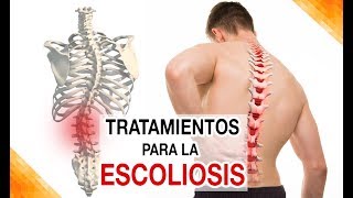 ¿Cuáles son los tratamientos para Escoliosis lumbar dorsal [upl. by Dewey]