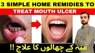 3 Home Remedies to Treat Mouth Ulcer  Canker Sores  Causes Symptoms and Treatment [upl. by Hackathorn]