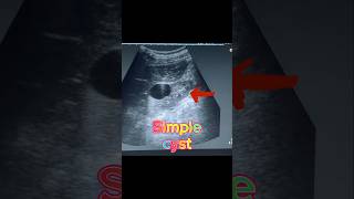 Simple Renal Cyst  Cortical Cyst  Kidney Cyst on Ultrasound [upl. by Quickman364]