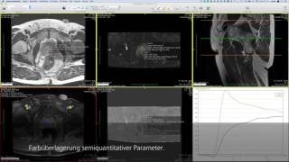 Dynamische Auswertung am Beispiel Prostata MRT [upl. by Nagad]