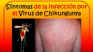 Virus Chikungunya Síntomas transmisión y prevención de la infección por Chikungunya [upl. by Grous103]