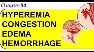 Pathology Hyperemia Congestion and Edema افضل شرح باثولوجي بالعربي الاحتقان والتورم د فادي مجدي [upl. by Anilahs]