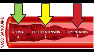 Hipertensión Arterial [upl. by Eanel]