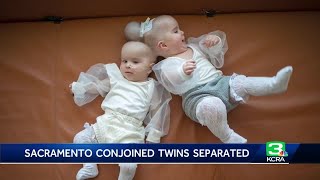 Celebrating a miracle Conjoined twin girls successfully separated at UC Davis Medical Center [upl. by Anilyx]