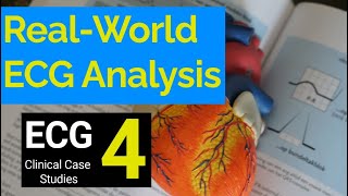 RealWorld ECG Analysis 4 Clinical Case Studies in Electrocardiography [upl. by Annaxor]