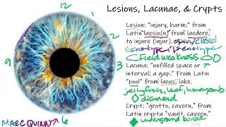 Iridology Lesson  Signs in the Iris Lesions Lacunae amp Crypts pt 1 [upl. by Chrystal57]