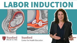 What is labor induction OBGYN answers 5 common questions about inducing labor  Stanford [upl. by Atiuqaj]