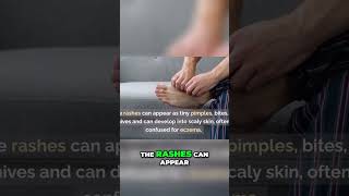 Scabies Symptoms Itching Rashes and Solutions [upl. by Aiciles]