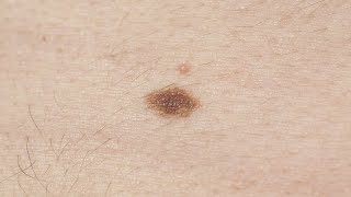 Melanoma symptoms How to spot signs and when to see a doctor [upl. by Anuahs]